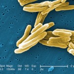 Tuberculosis: Una enfermedad de 70,000 años, presentada apenas en 1882