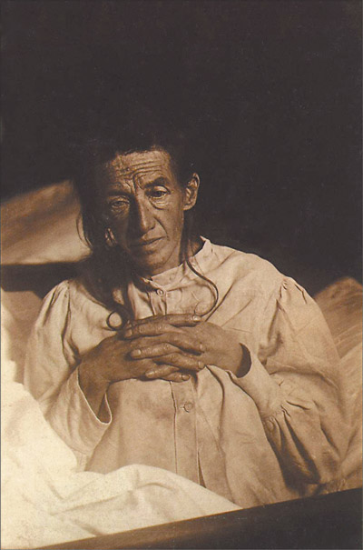 La paciente Auguste Deter, la primera a quien se le identifico el alzheimer