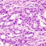Las células madre tumorales del páncreas pueden morir ‘asfixiadas’