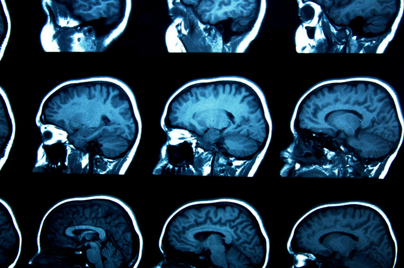 Las metástasis cerebrales podrían necesitar un tratamiento distinto al del tumor primario