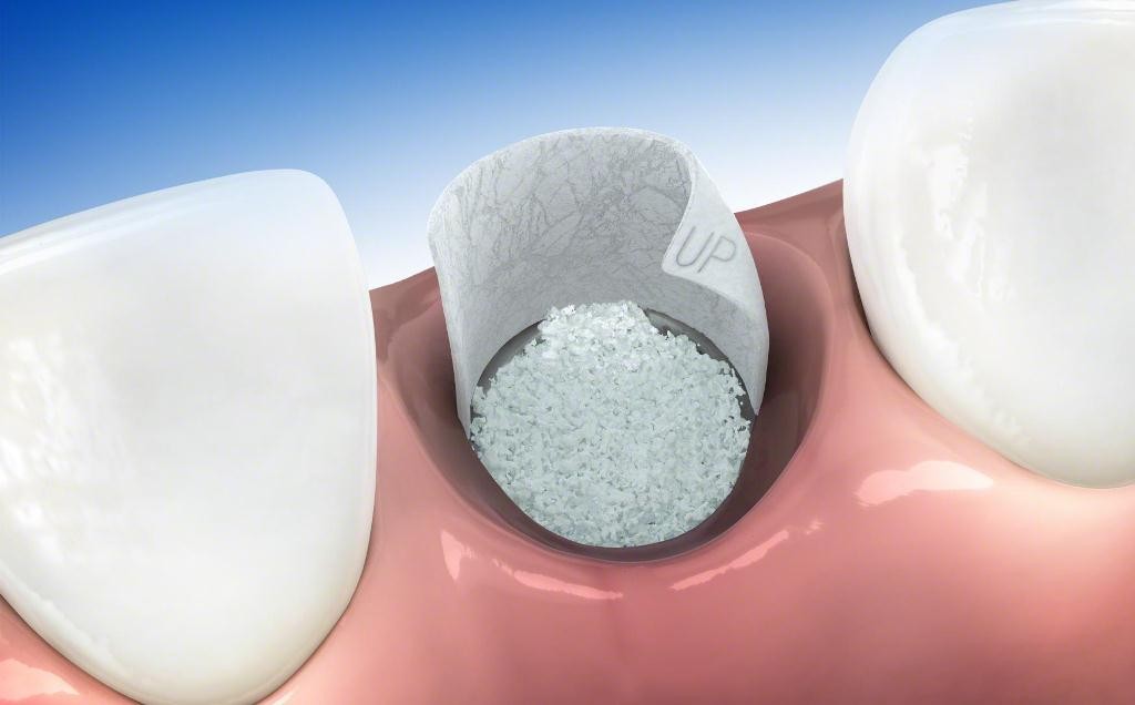Mejoran la regeneración ósea en cirugía bucal