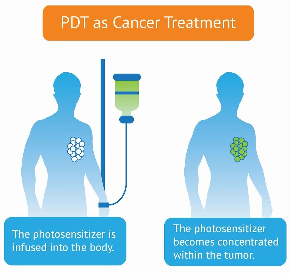 Inmunoterapia y terapia fotodinámica contra el cáncer