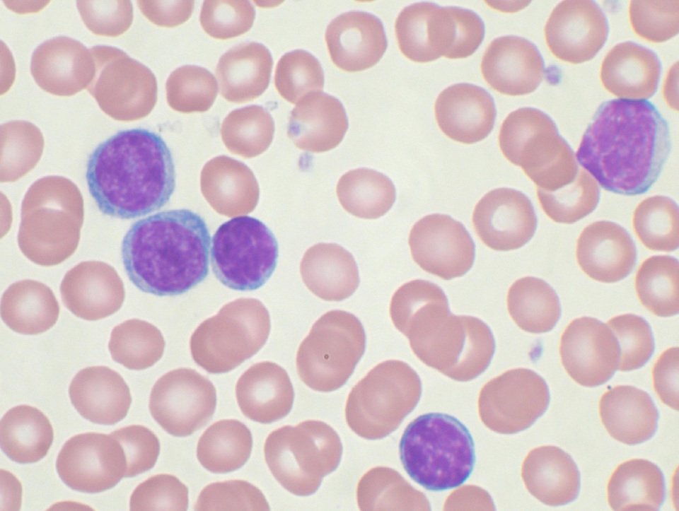 Frote sanguíneo mostrando linfocitos (morados) en una leucemia linfocítica crónica (LLC)- Wikipedia