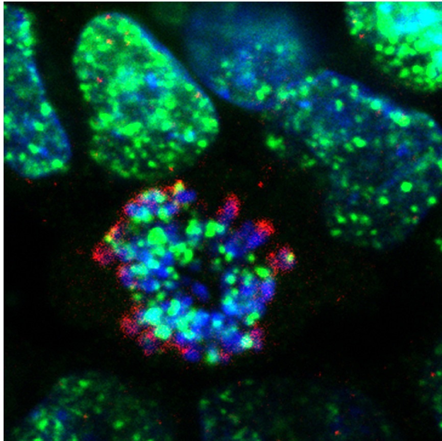 Célula tumoral tratada con los inhibidores de ATR desarrollados en el CNIO. En verde, las roturas en el ADN de las células generadas por el tratamiento. En azul, los cromosomas. / CNIO