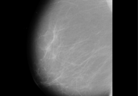 Detalle de una de las mamografías utilizadas durante la investigación. / URV