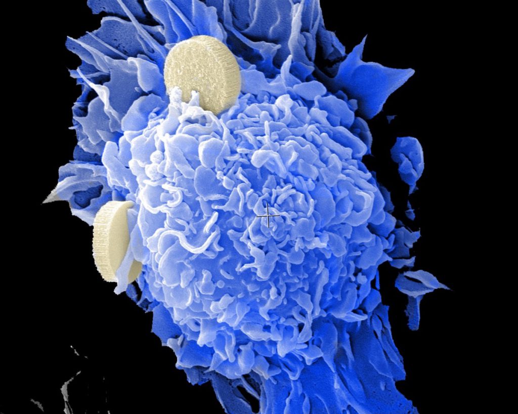 Nanovacunas contra el cáncer entrando en células dendriíticas- NCI
