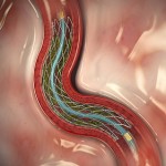 Matemática cardiovascular: simulación computacional en la prevención, diagnóstico y tratamiento de enfermedades 