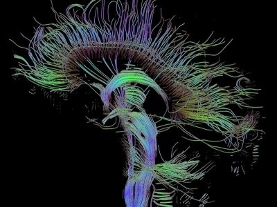 1 / 1 Los científicos han fijado su atención en el estudio de las conexiones neuronales que se establecen en el cerebro cuando hay trastornos neuropsiquiátricos.