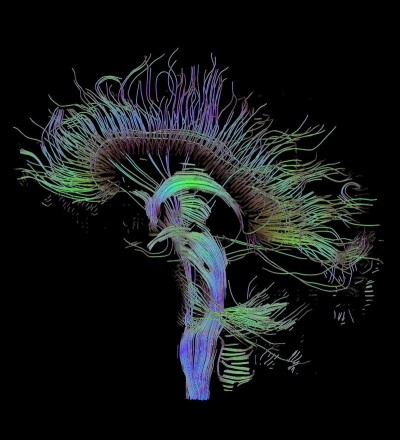 1 / 1 Los científicos han fijado su atención en el estudio de las conexiones neuronales que se establecen en el cerebro cuando hay trastornos neuropsiquiátricos.