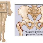 Envejecimiento de la población aumenta fracturas por enfermedades del hueso