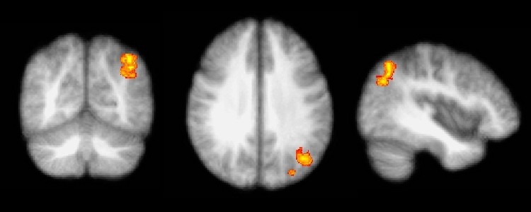 Un estudio relaciona el vértigo recurrente y la ansiedad