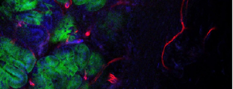 Descubierta la huella genética de los tumores de colon agresivos