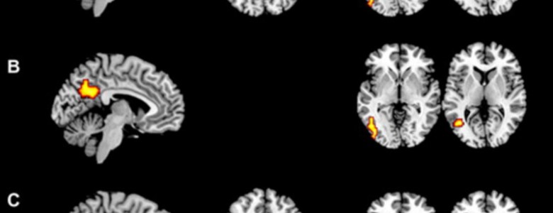 Los bilingües presentan diferencias en el cerebro al hablar su lengua materna