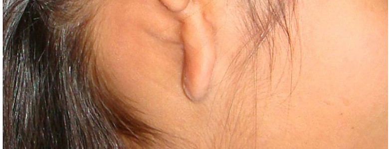 Reconstruyen pabellones auriculares con cartílago de costilla