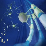 Dos fármacos cutáneos regeneran neuronas dañadas por esclerosis múltiple