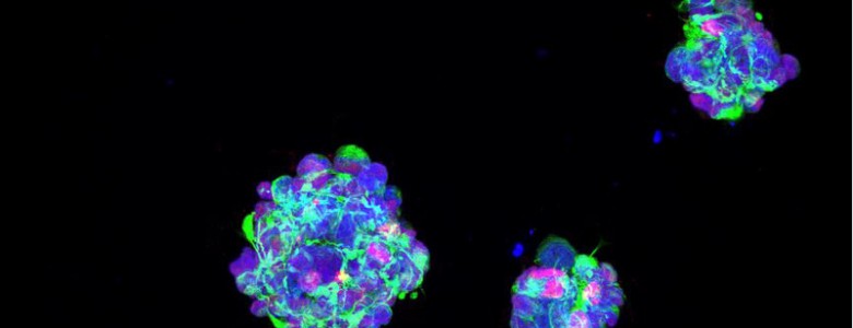Microesferas para atacar el tumor cerebral más agresivo