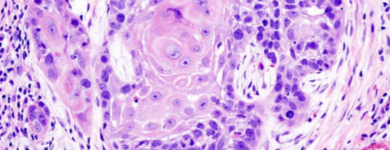 Un dispositivo portátil diagnostica cáncer oral con láser