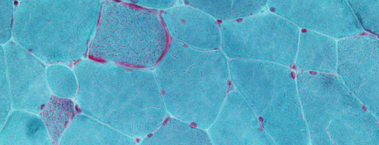 Unas ‘tijeras’ moleculares cortan las mutaciones que causan enfermedades hereditarias