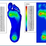 Crean unas plantillas que reducen la presión en los pies de pacientes diabéticos