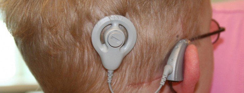 Los implantes cocleares en edad temprana mejoran la comprensión lectora de los niños Los implantes cocleares en edad temprana mejoran la comprensión lectora de los niños
