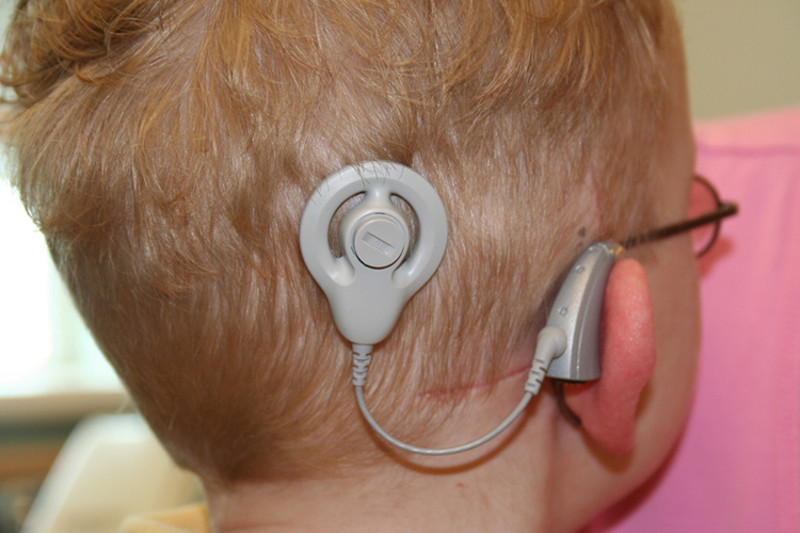 Los implantes cocleares en edad temprana mejoran la comprensión lectora de los niños