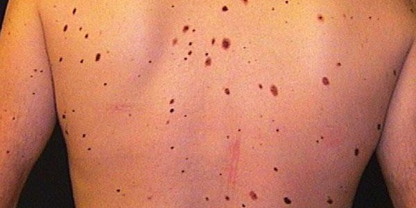 El seguimiento del cáncer de piel permite detectar el 78% de las recaídas