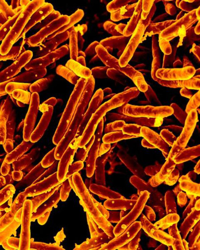 Identificado un gen para medir la susceptibilidad a la tuberculosis