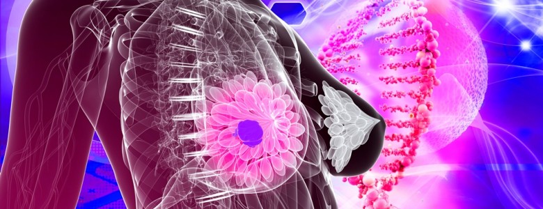 Cáncer de mama