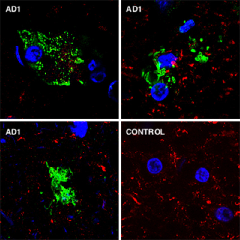 Análisis de estructuras fúngicas en tejido de cerebro mediante inmunohistoquímica. El tejido cerebral de un individuo control (C1) es negativo, mientras que varias muestras de un paciente con enfermedad de Alzheimer (AD1) son positivas. Los núcleos celulares se han teñido con DAPI (azul), las estructuras fúngicas se evidencian mediante el uso de anticuerpos específicos (verde) y los neurofilamentos humanos se muestran en rojo- UAM