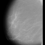 Un programa diagnostica en las mamografías el 99% de los tumores