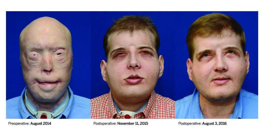 La evolución de Patrick Hardison, con su trasplante de cara