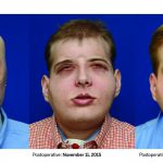 La evolución de Patrick Hardison, el primero sometido a un trasplante de cara completo