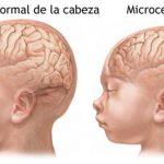 Sin precisar aún la relación entre el Zika y la microcefalia