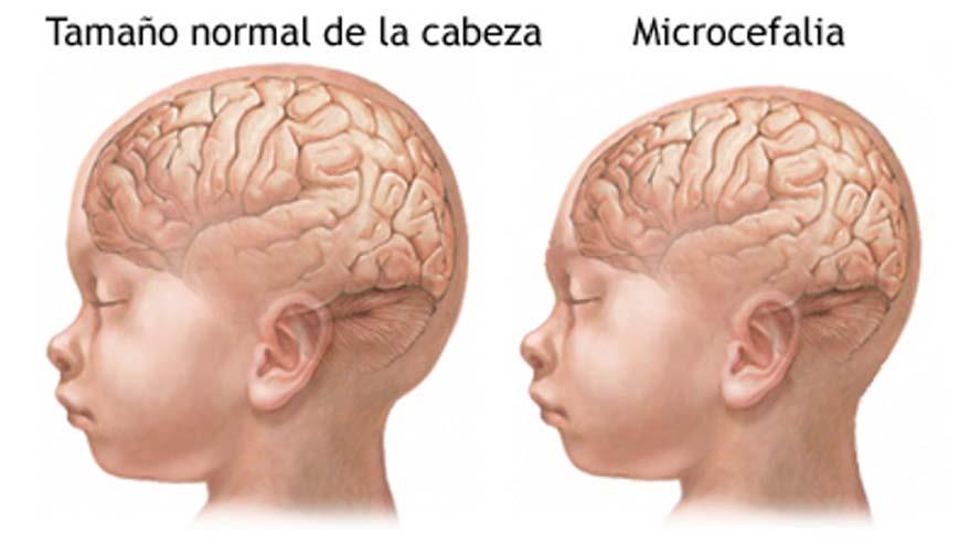 Microcefalia- MedLine Plus