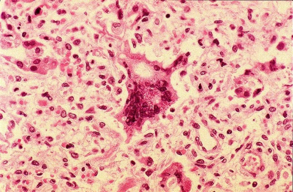 Células infectadas por el virus del sarampión- Fofo CDC