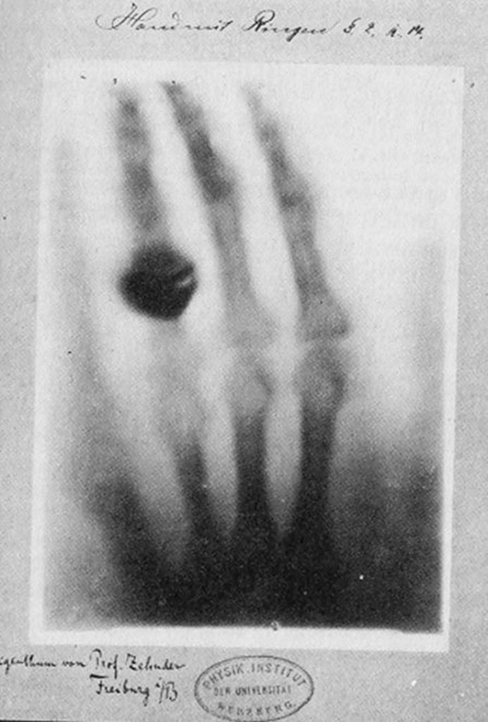 Rayos X de la mano de la esposa de Röntgen, la primera radiografia del mundo