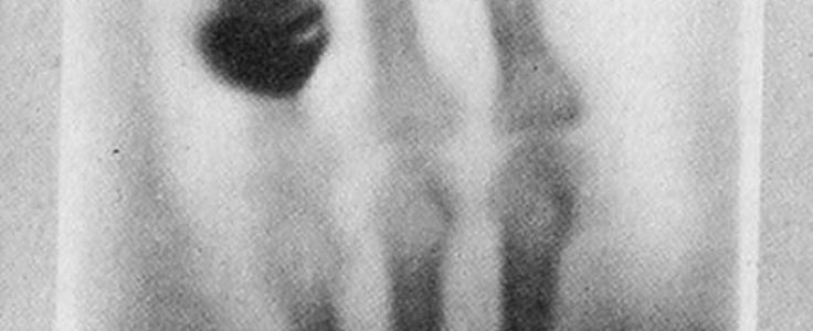 Rayos X de la mano de la esposa de Röntgen, la primera radiografia del mundo