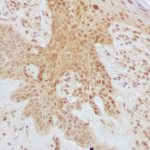 Las células tumorales dependen de las grasas para iniciar metástasis