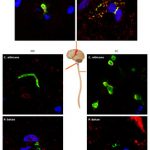 Infecciones por hongos en el cerebro relacionadas con la esclerosis lateral amiotrófica