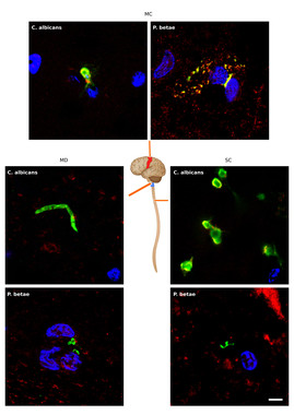 Presencia de estructuras fúngicas en distintas partes del sistema nervioso central de un paciente de ELA detectadas mediante inmunohistoquímica- UAM