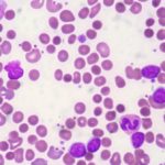 500 variaciones de ADN tiene la sangre de los enfermos de leucemia linfática crónica