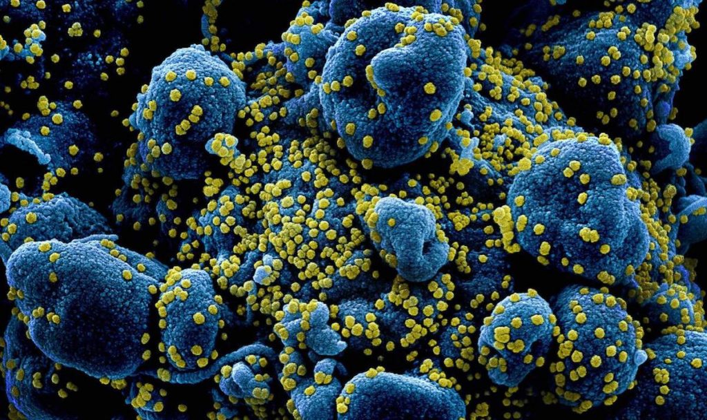 Partículas del virus SARS-COV-2 (en amarillo) infectando células (azuladas) aisladas de un paciente y vistas a través del microscopio electrónico de barrido con corrección de color- NIAID