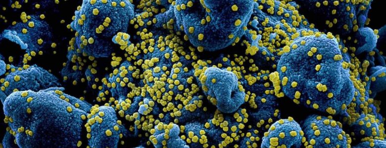 Partículas del virus SARS-COV-2 (en amarillo) infectando células (azuladas) aisladas de un paciente y vistas a través del microscopio electrónico de barrido con corrección de color- NIAID
