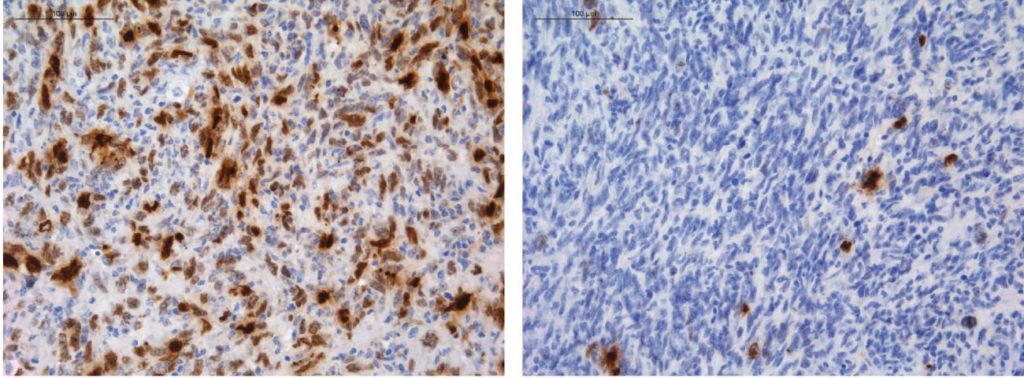Células de glioma (en azul) bajo tratamiento con temozolomida, con daño en el ADN marcado en color marrón- CNIO